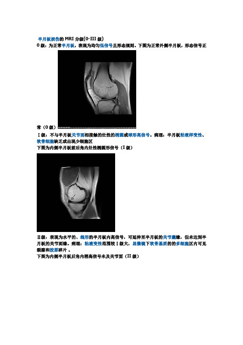 半月板损伤的MRI分级