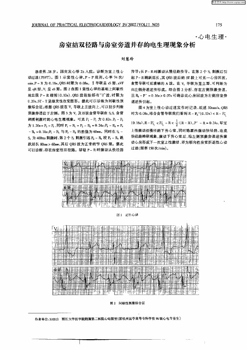 房室结双径路与房室旁道并存的电生理现象分析