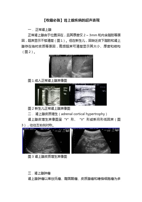 【收藏必备】肾上腺疾病的超声表现