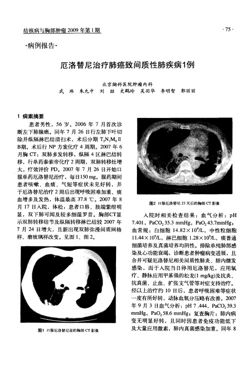 厄洛替尼治疗肺癌致间质性肺疾病1例