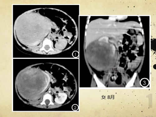 肾母细胞瘤  ppt课件