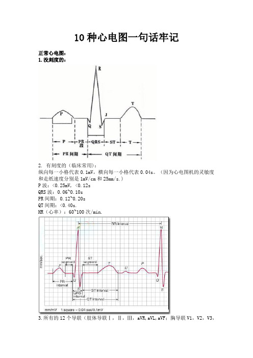 10种心电图一句话牢记