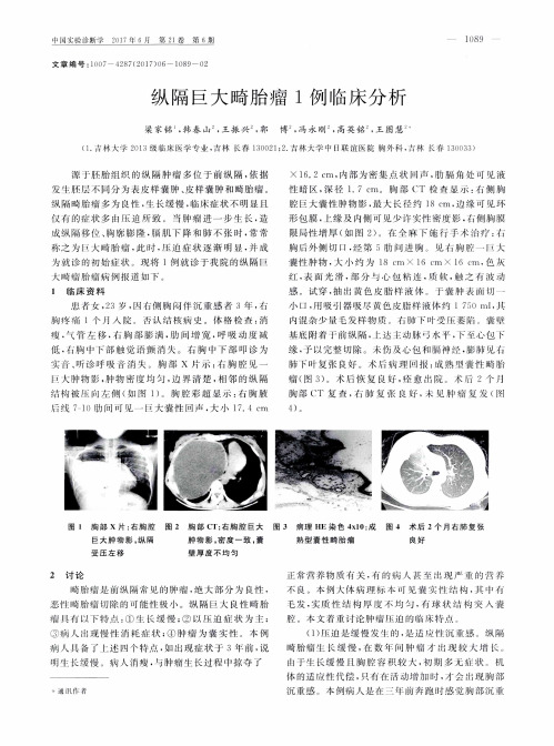 纵隔巨大畸胎瘤1例临床分析