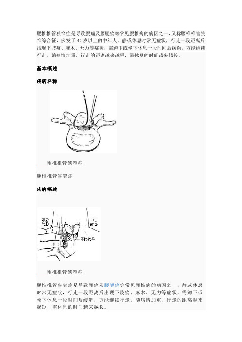 腰椎椎管狭窄症是导致腰痛及腰腿痛等常见腰椎病的病因之一,又称腰椎椎管狭窄综合征,多发于40岁以上的中年