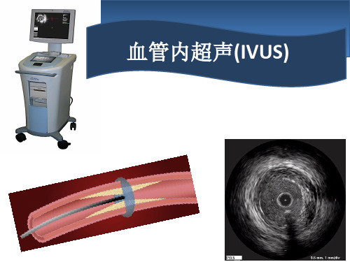 血管内超声IVUS简介课件