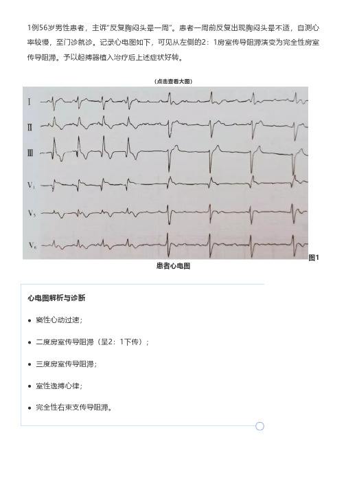 房室传导阻滞,心电图有何特征？