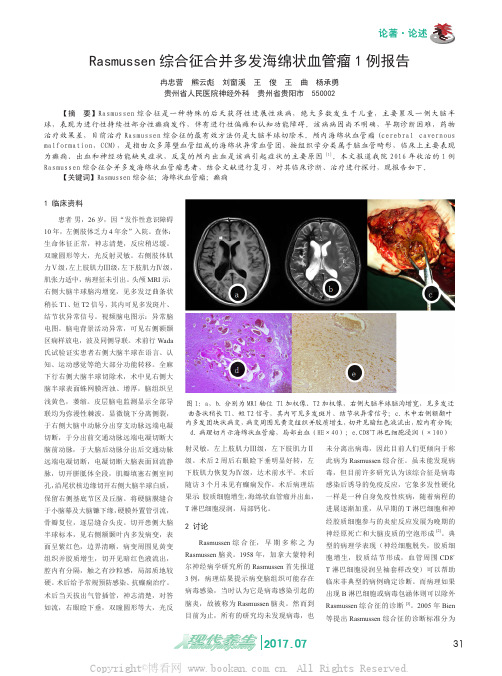 Rasmussen 综合征合并多发海绵状血管瘤1 例报告