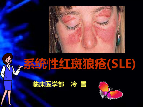 2系统性红斑狼疮(SLE)