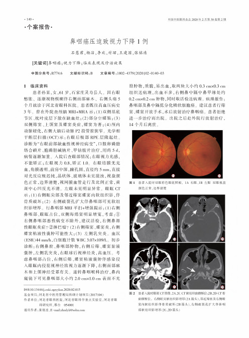 鼻咽癌压迫致视力下降1例