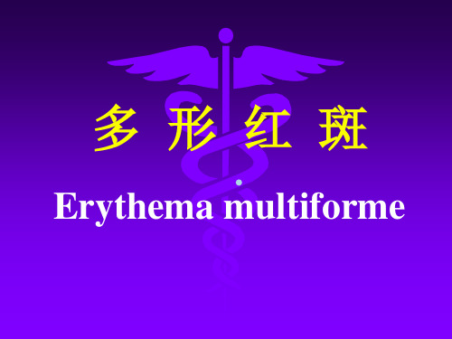 (PPT)多形红斑Erythemamultiforme