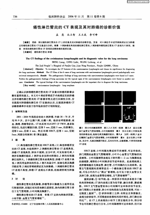 癌性淋巴管炎的CT表现及其对肺癌的诊断价值