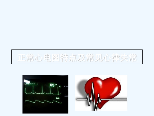 临床常见的异常心电图