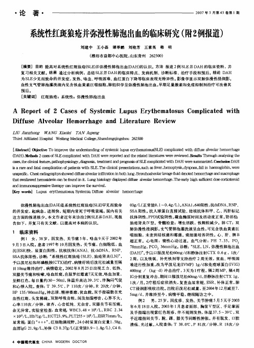 系统性红斑狼疮并弥漫性肺泡出血的临床研究(附2例报道)