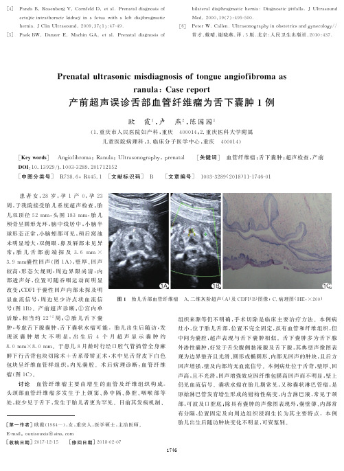 产前超声误诊舌部血管纤维瘤为舌下囊肿1例