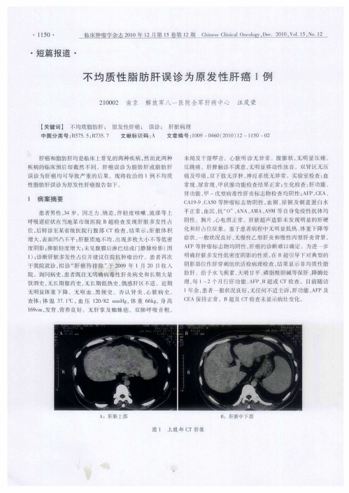 不均质性脂肪肝误诊为原发性肝癌1例