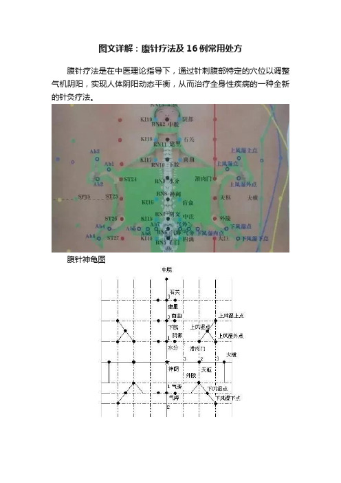 图文详解：腹针疗法及16例常用处方