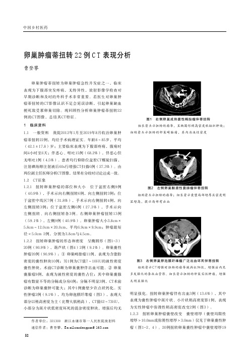 卵巢肿瘤蒂扭转22例CT表现分析