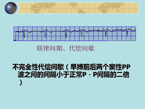 联律间期、代偿间歇