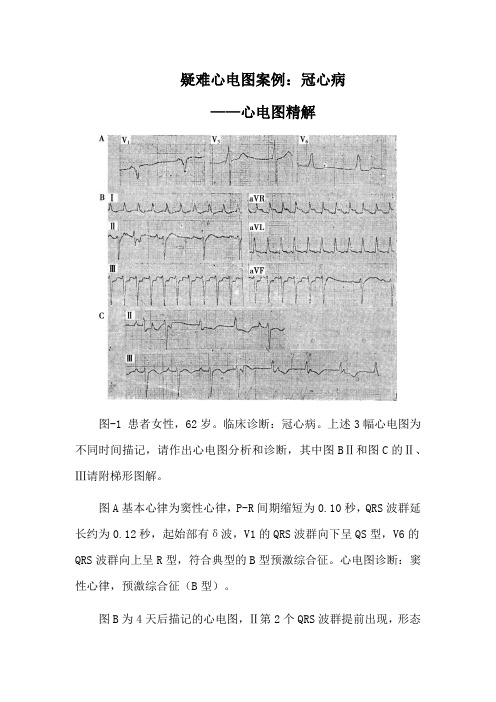 疑难心电图案例：冠心病1——心电图精解