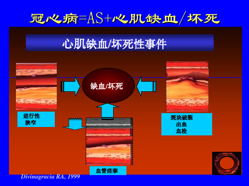 非ST段抬高型ACSNSTEACS危险评估与介入治疗时机