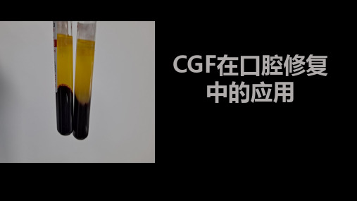 CGF在口腔修复中的应用