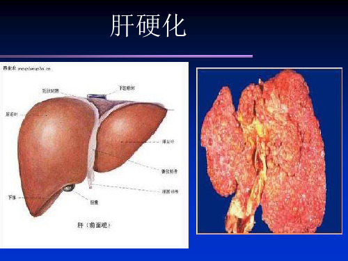 内科学肝硬化培训课件