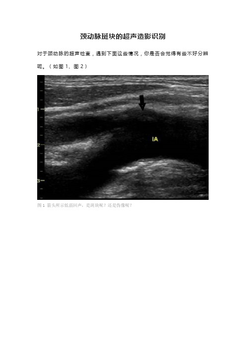 颈动脉斑块的超声造影识别