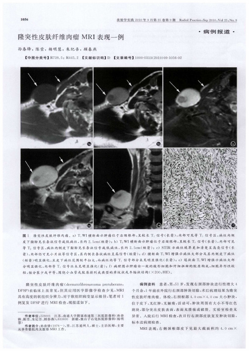 隆突性皮肤纤维肉瘤MRI表现一例