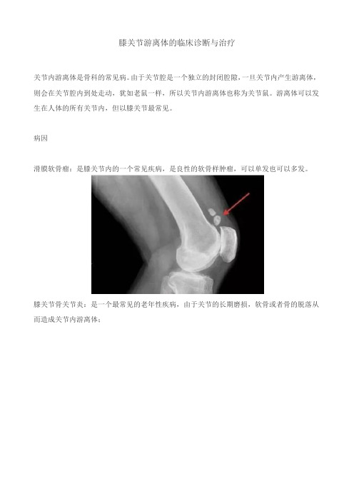 膝关节游离体的临床诊断与治疗