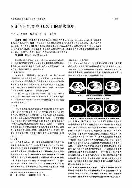 肺泡蛋白沉积症HRCT的影像表现