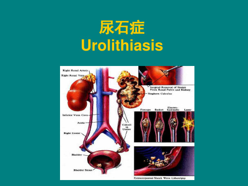 泌尿系结石ppt课件ppt课件