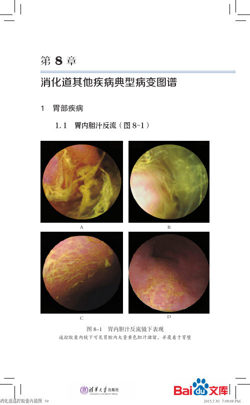 消化道遥控胶囊内镜第八章消化道其他疾病典型病变图谱