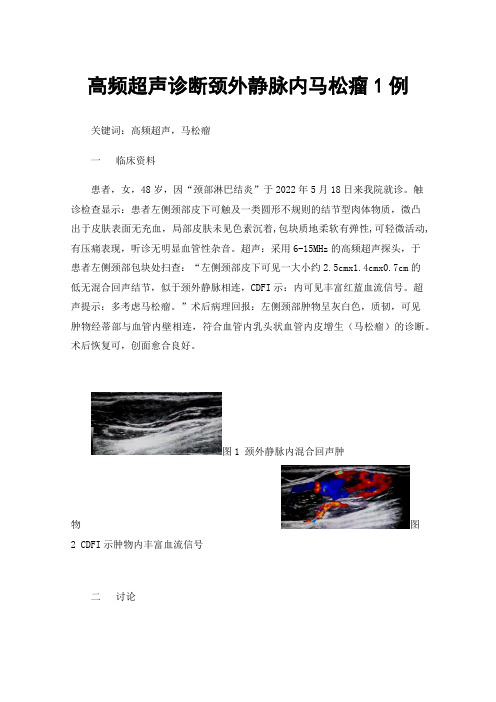 高频超声诊断颈外静脉内马松瘤1例