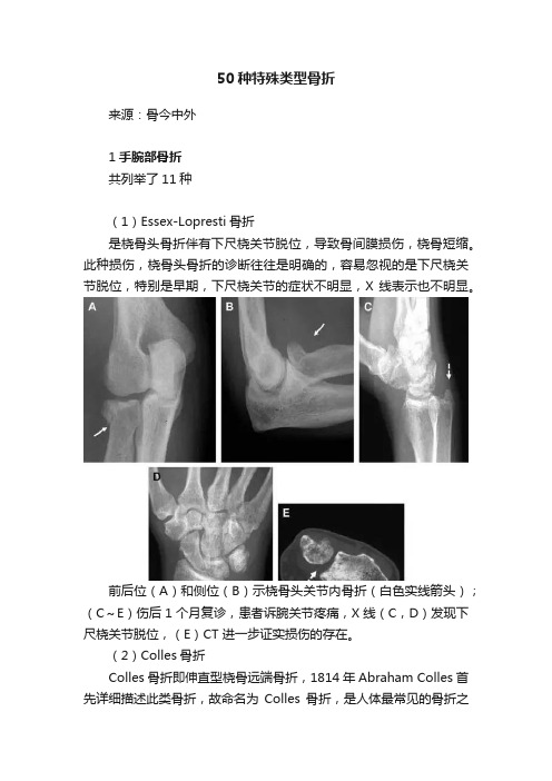 50种特殊类型骨折