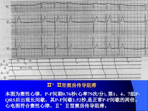 Ⅱ°Ⅱ型窦房传导阻滞