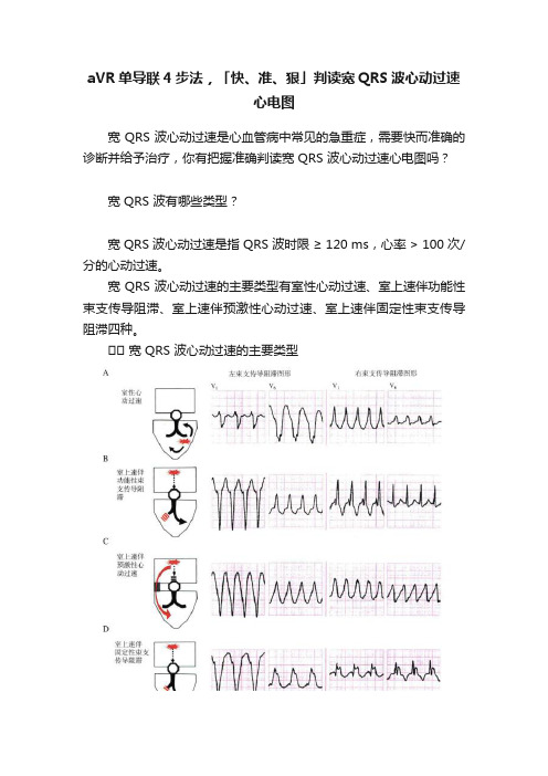 aVR单导联4步法，「快、准、狠」判读宽QRS波心动过速心电图