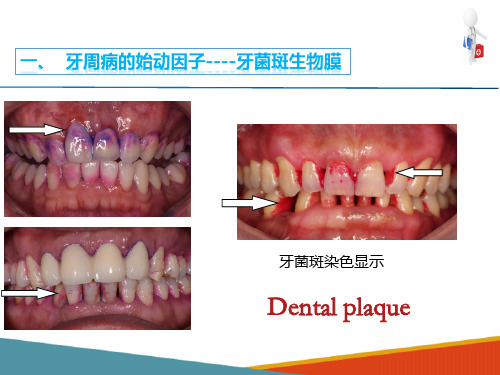 牙周病概述 牙周病的发病因素 牙菌斑生物膜