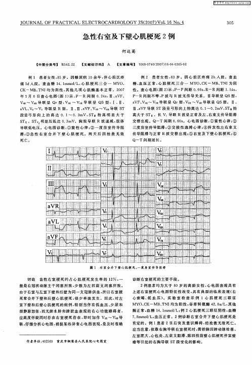 急性右室及下壁心肌梗死2例