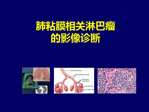 肺粘膜相关淋巴瘤的影像学诊断 -优秀医学PPT课件