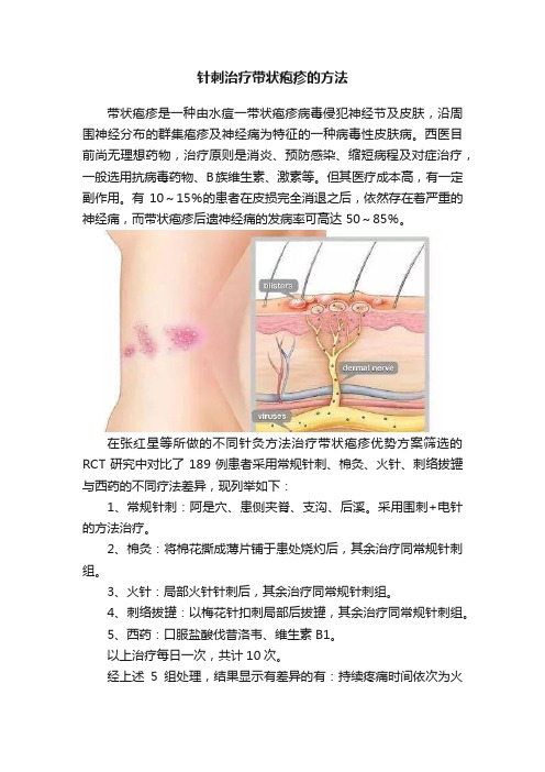 针刺治疗带状疱疹的方法