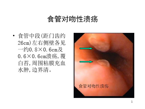 典型内镜图片ppt课件