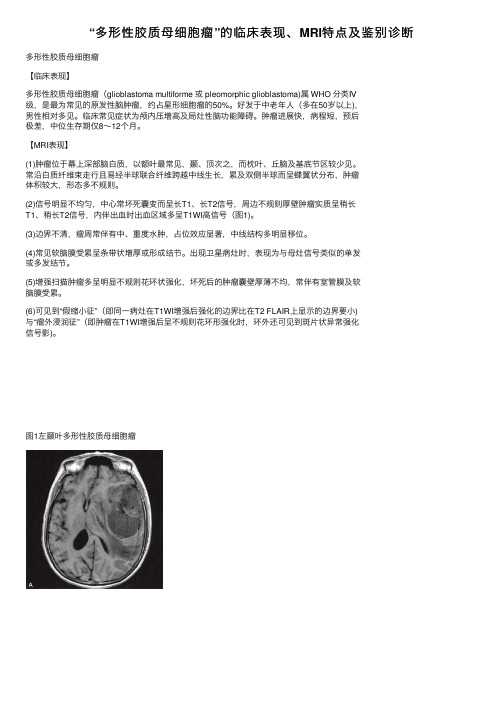 “多形性胶质母细胞瘤”的临床表现、MRI特点及鉴别诊断