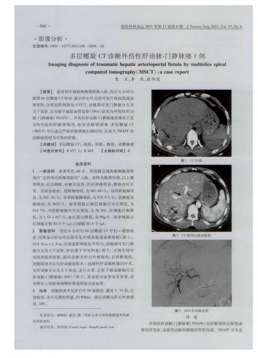 多层螺旋CT诊断外伤性肝动脉-门静脉瘘1例