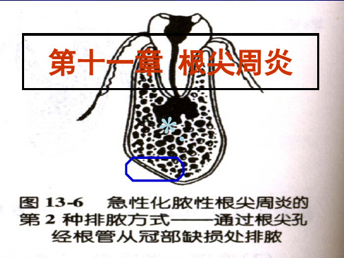 根尖周炎(课堂PPT)