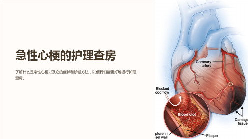 急性心梗的护理查房