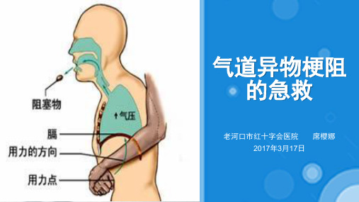 气道异物梗阻的急救(1)