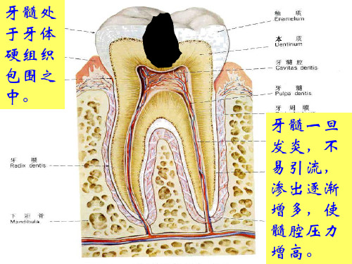 牙髓炎的治疗方法PPT.