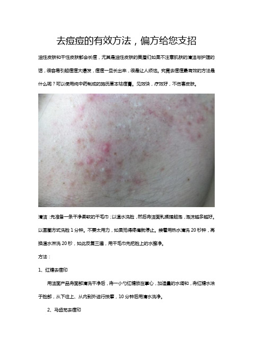 去痘痘的有效方法,偏方给您支招