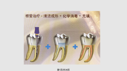 根管充填材料