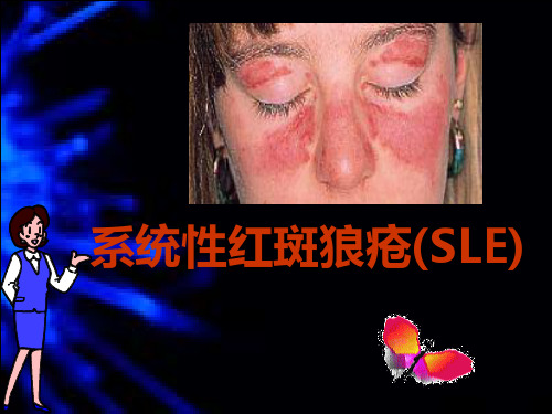 系统性红斑狼疮(SLE)ppt课件